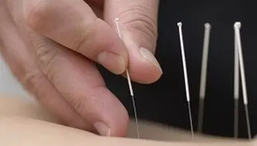 آیا طب سوزنی برای آلرژی و حساسیت فصلی کارایی دارد؟