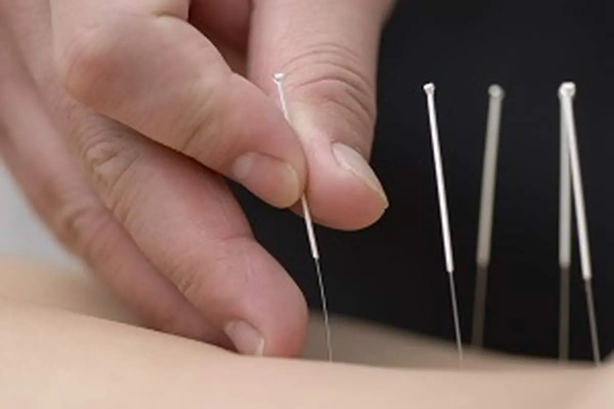 آیا طب سوزنی برای آلرژی و حساسیت فصلی کارایی دارد؟