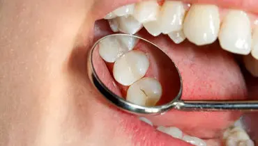 ساکنان این استان بیشترین دندان خراب را دارند