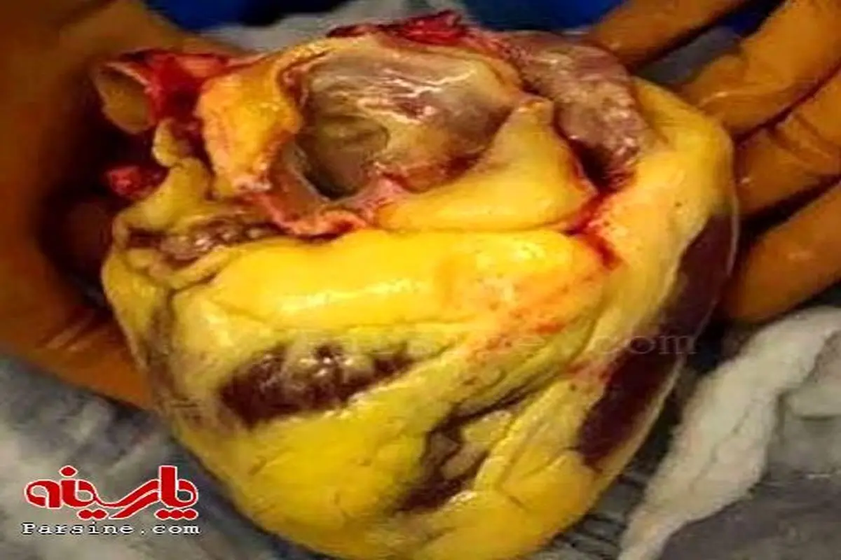 عکس:قلب شخص چاق فوت شده در اثر سکته قلبی