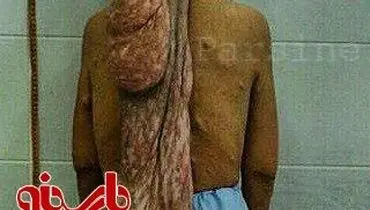 عکس:تومور هفتاد سانتی!
