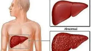 خوراکی‌های مفید و مضر برای کبد چرب