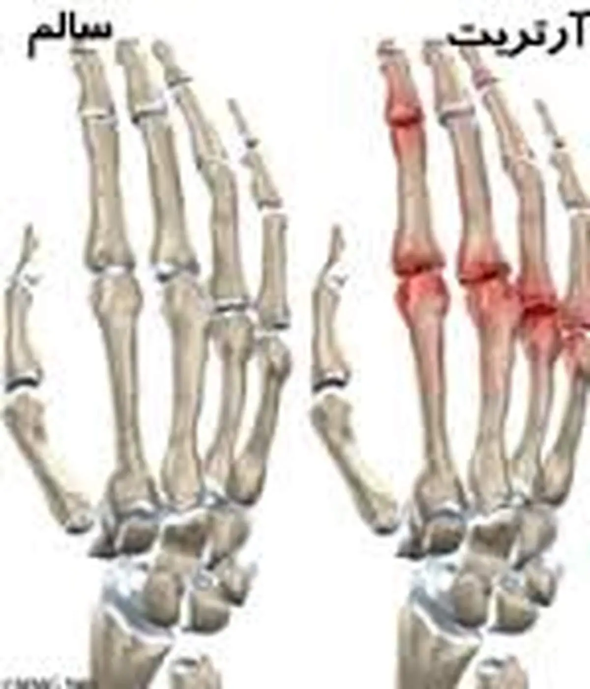 هشت باور غلط رایج درباره آرتریت روماتوئید