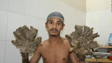 مرد درختی بنگلادشی + تصاویر