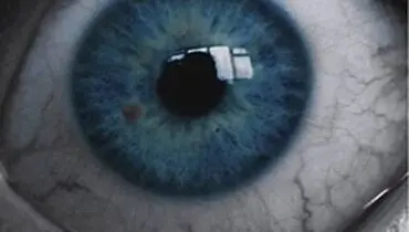 تشخیص آلزایمر از روی چشم
