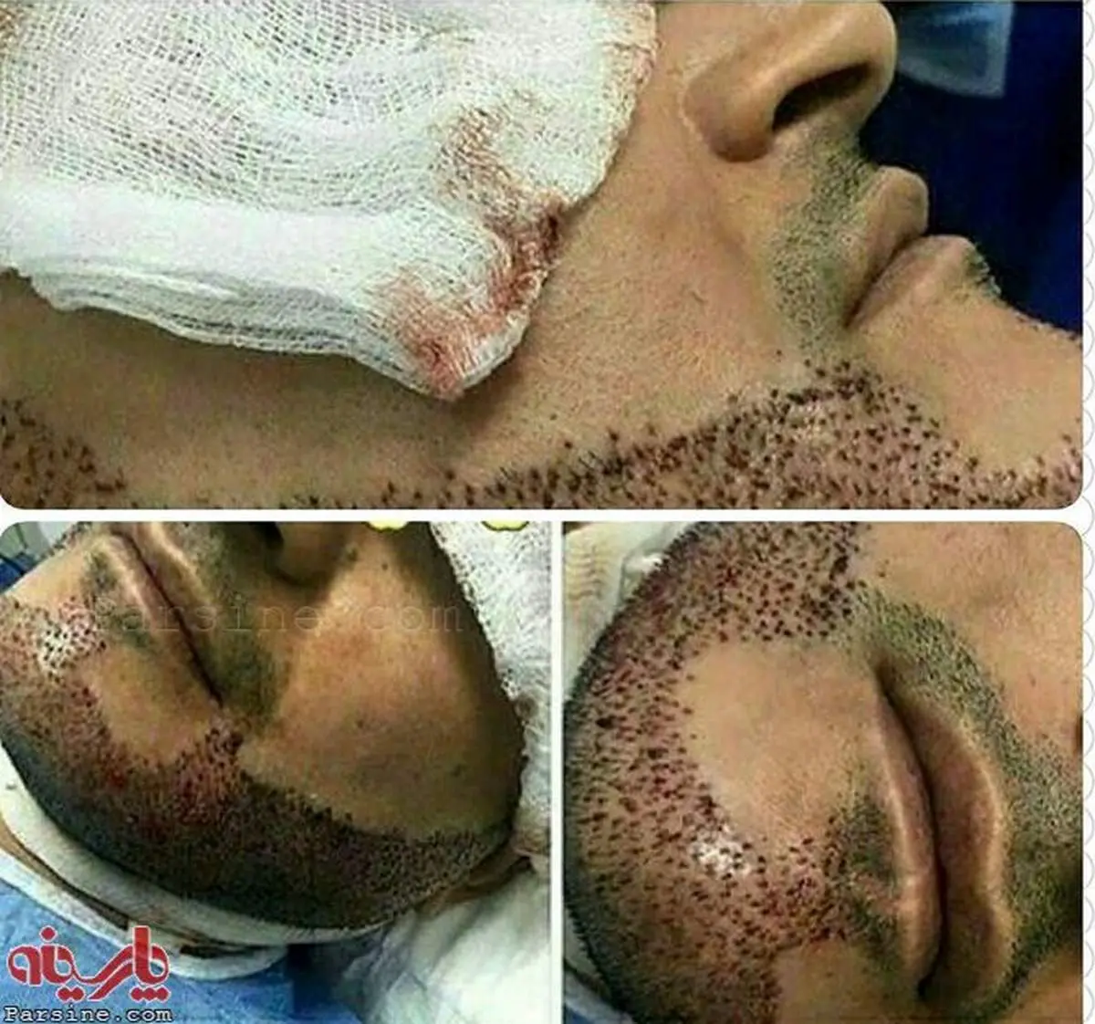 عمل جراحی کاشت ریش!