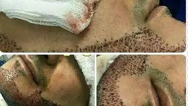 عمل جراحی کاشت ریش!