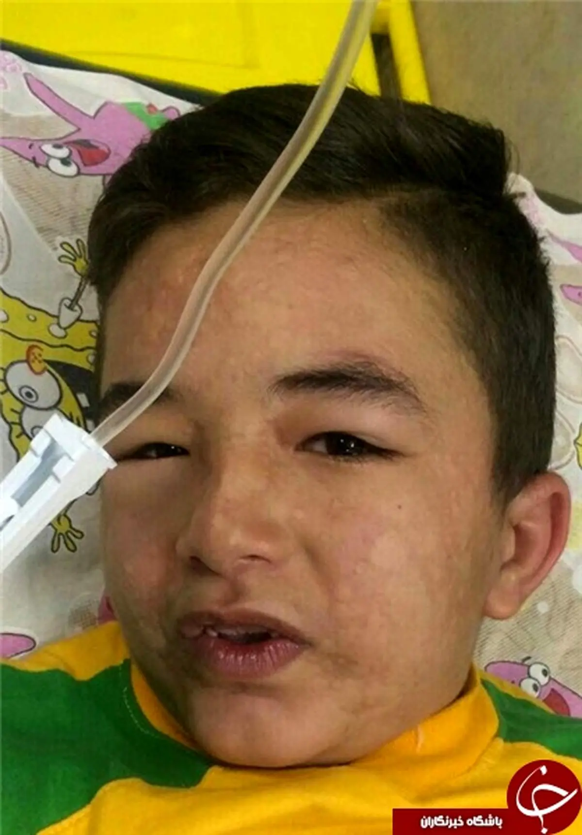 شوک کودک ۸ ساله پس از تزریق پنی‌سیلین