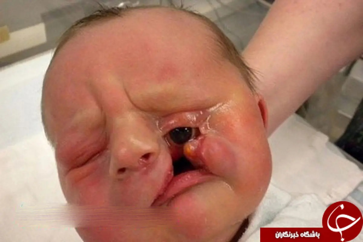 بیماری مادر زادی که چشم کودک را بلعید