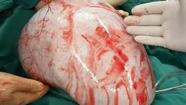 خروج توده ۷ کیلویی از شکم یک زن
