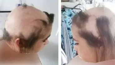 بلایی که استرس بر سر این دختر آورد