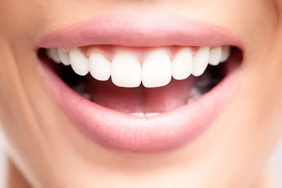 گرایش جوانان به داشتن دندان‌های درشت و سفید