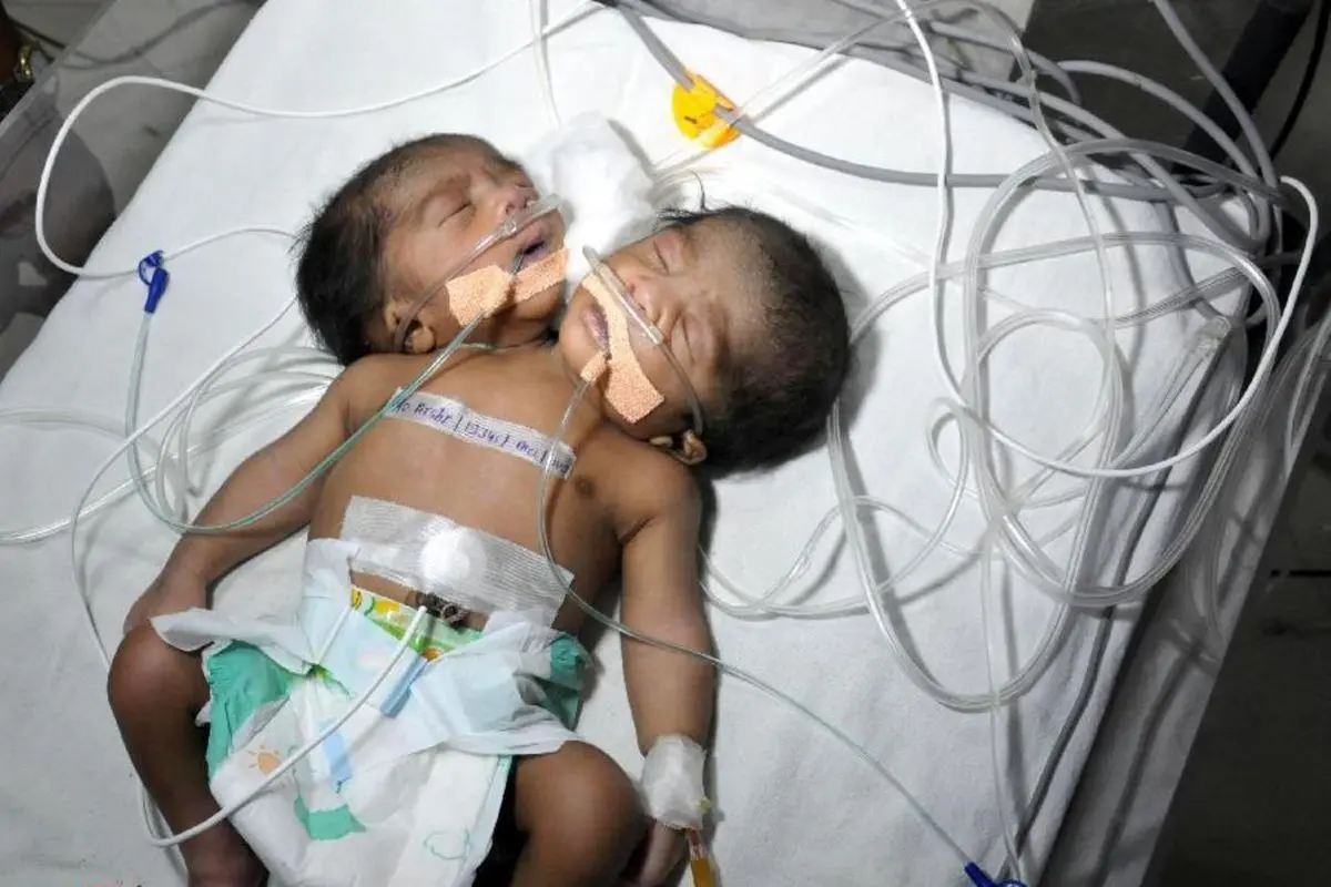 تولد پسر ۲ سر در هند +عکس