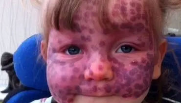 ماه‌گرفتگی نادر روی پوست یک کودک+تصاویر
