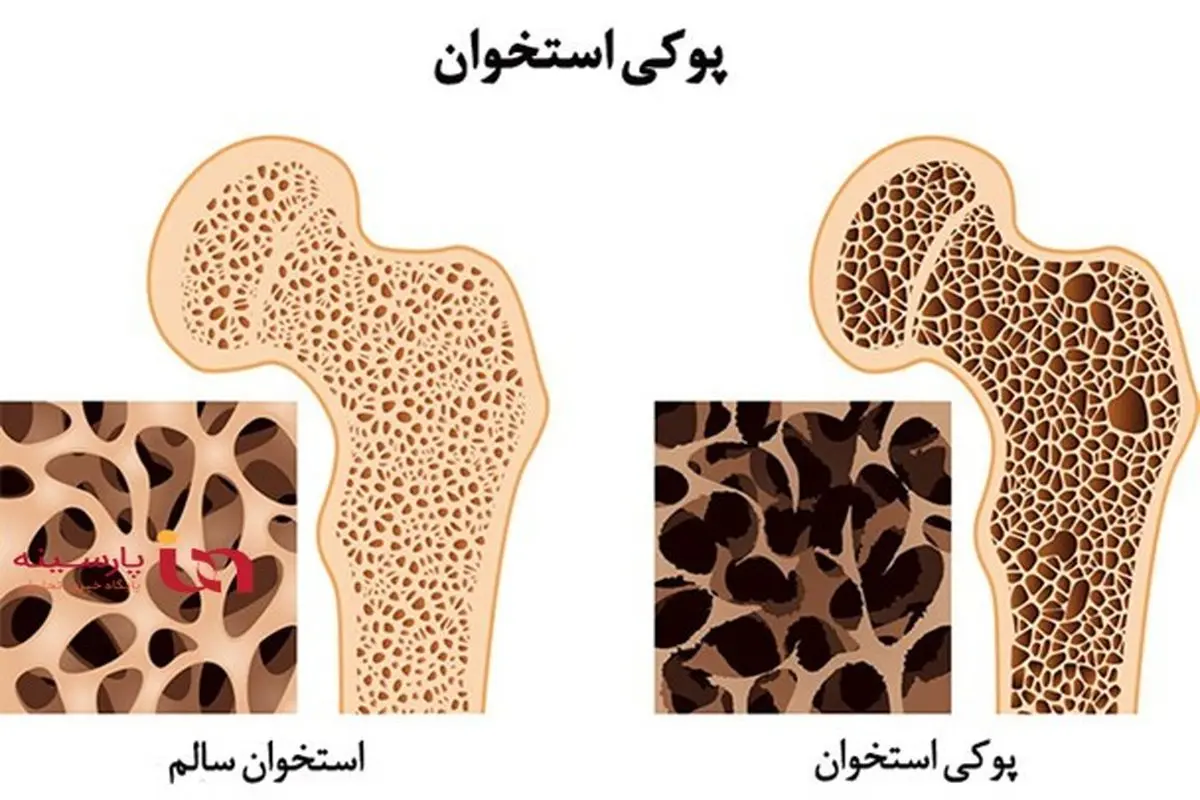 این خوراکی ها دشمن استخوان هستند