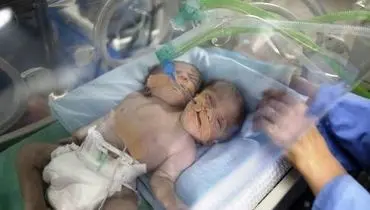 بدنیا آمدن نوزادی با ۲ سر و یک بدن! +عکس
