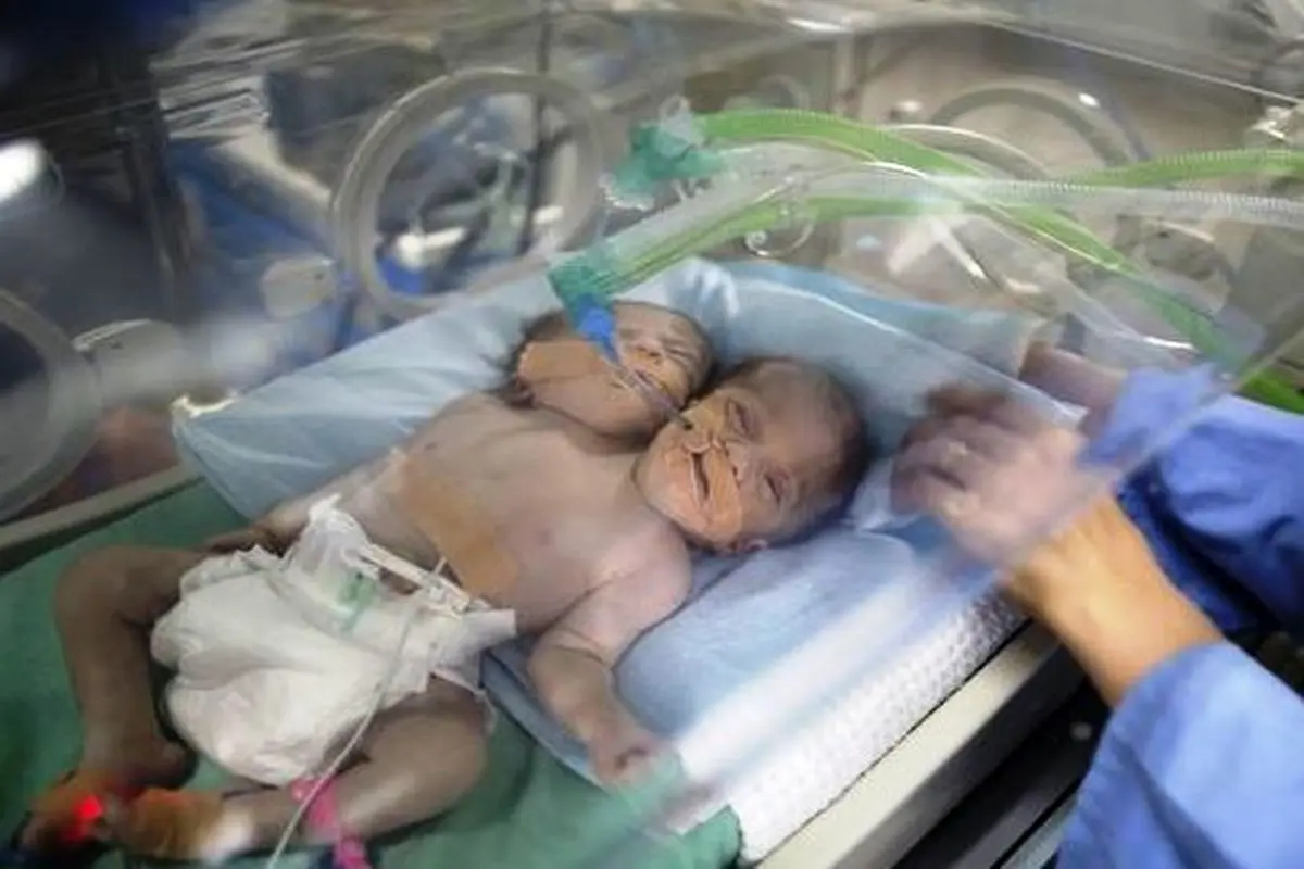 بدنیا آمدن نوزادی با ۲ سر و یک بدن! +عکس