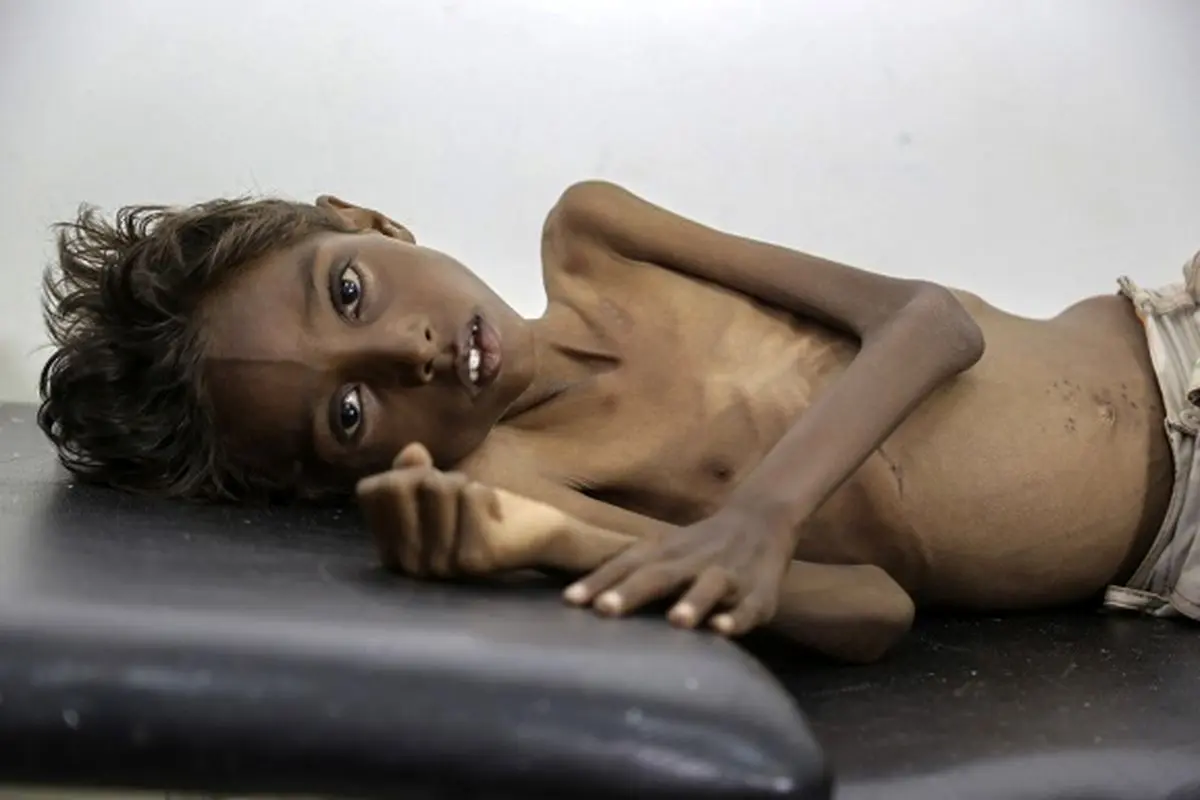 روایت دردناک آسوشیتدپرس از رنج کودکان یمنی