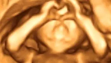 ژست عجیب جنین درون شکم مادرش +عکس