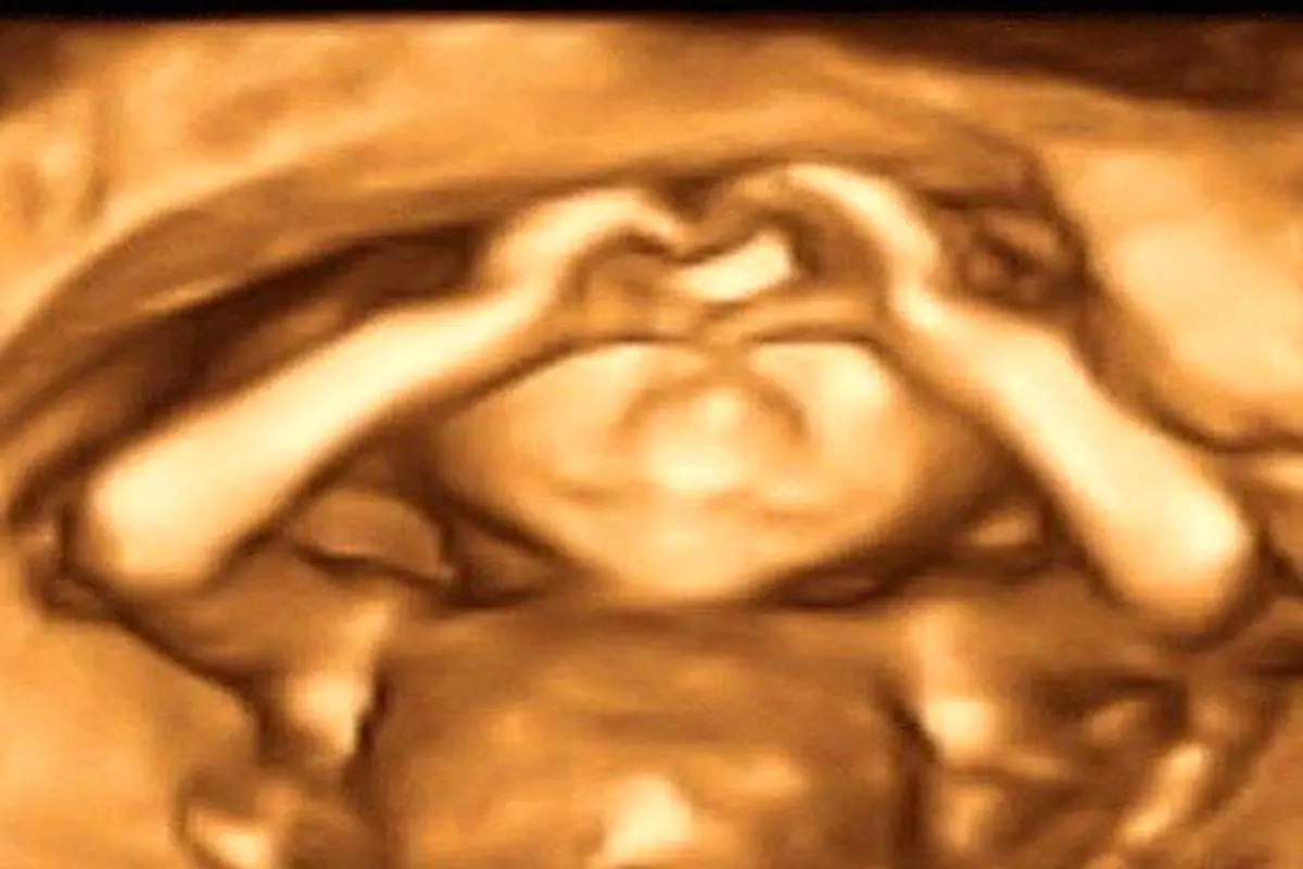 ژست عجیب جنین درون شکم مادرش +عکس