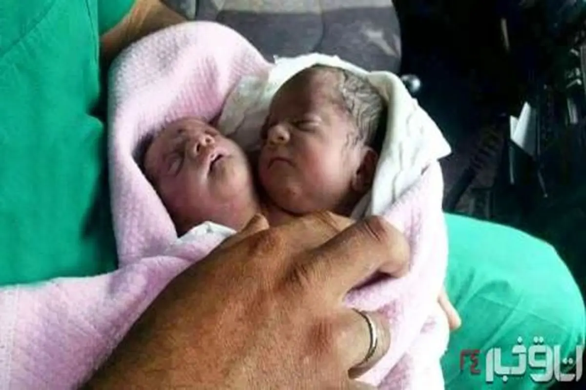 تصویری از تولد نوزاد دو سر در سوریه