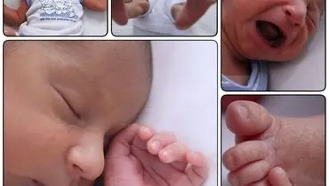 تولد نوزادی با ۲۴ انگشت درشهرستان گناباد