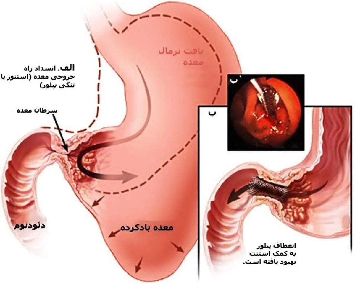 چرا سرطان معده می‌گیریم؟