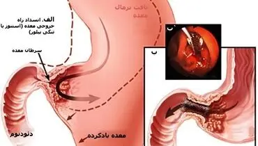 چرا سرطان معده می‌گیریم؟