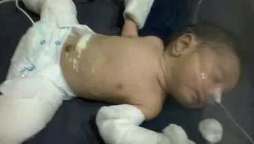 نوزادی که باردار به دنیا آمد!