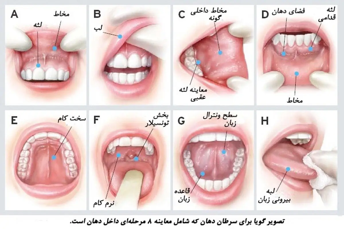 زخم در دهان نشانه چیست؟