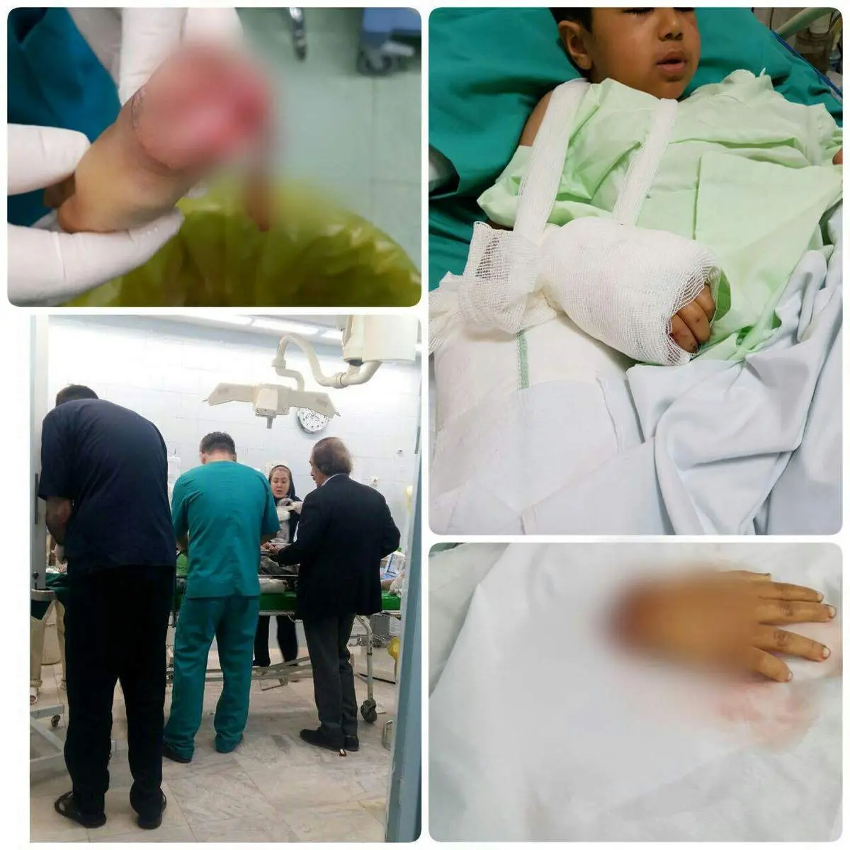 پیوند دست قطع شده کودک زلزله زده+عکس