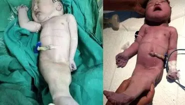 تولد نوزادی به شکل پری دریایی در هند+عکس