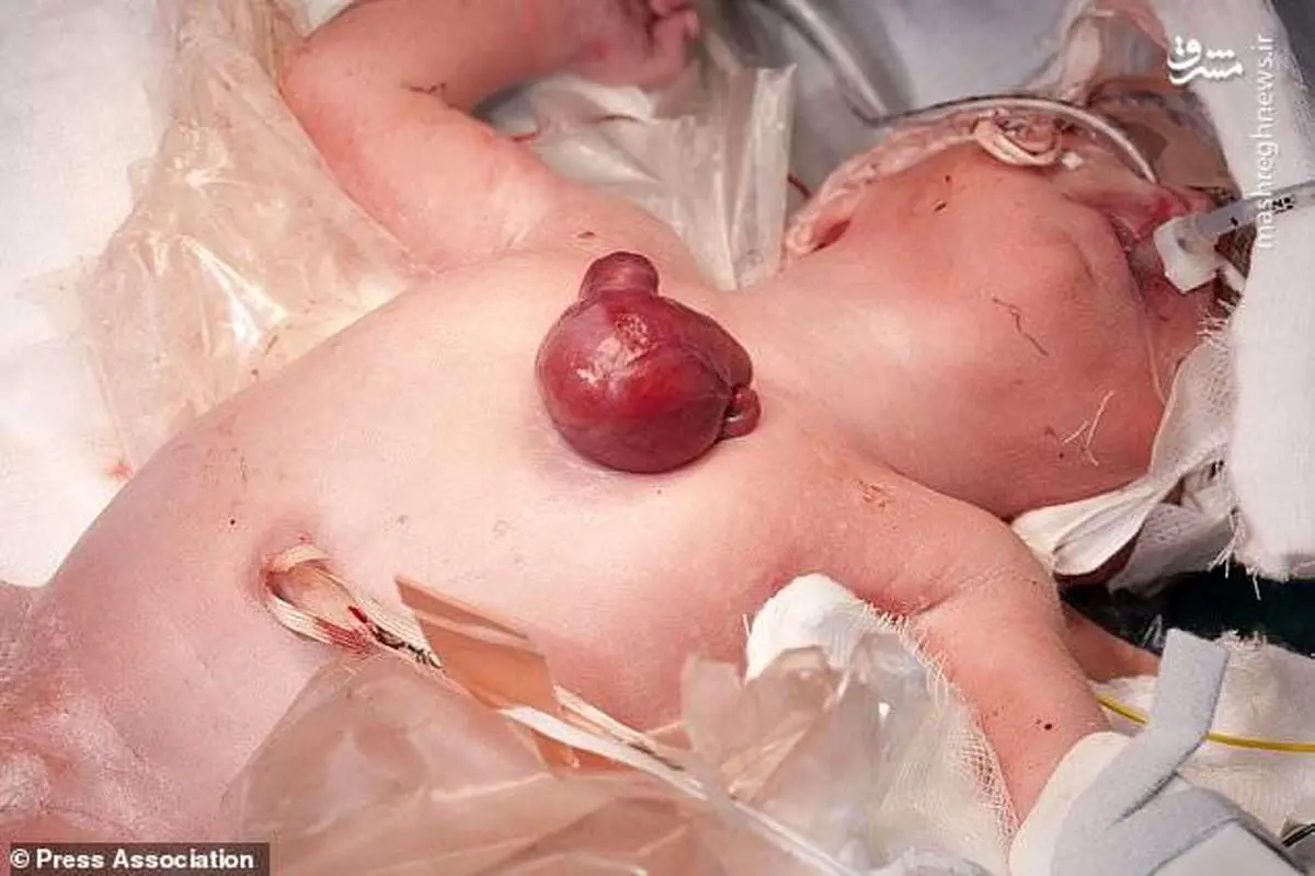 کودکی که قلبش خارج از سینه‌اش بود+عکس