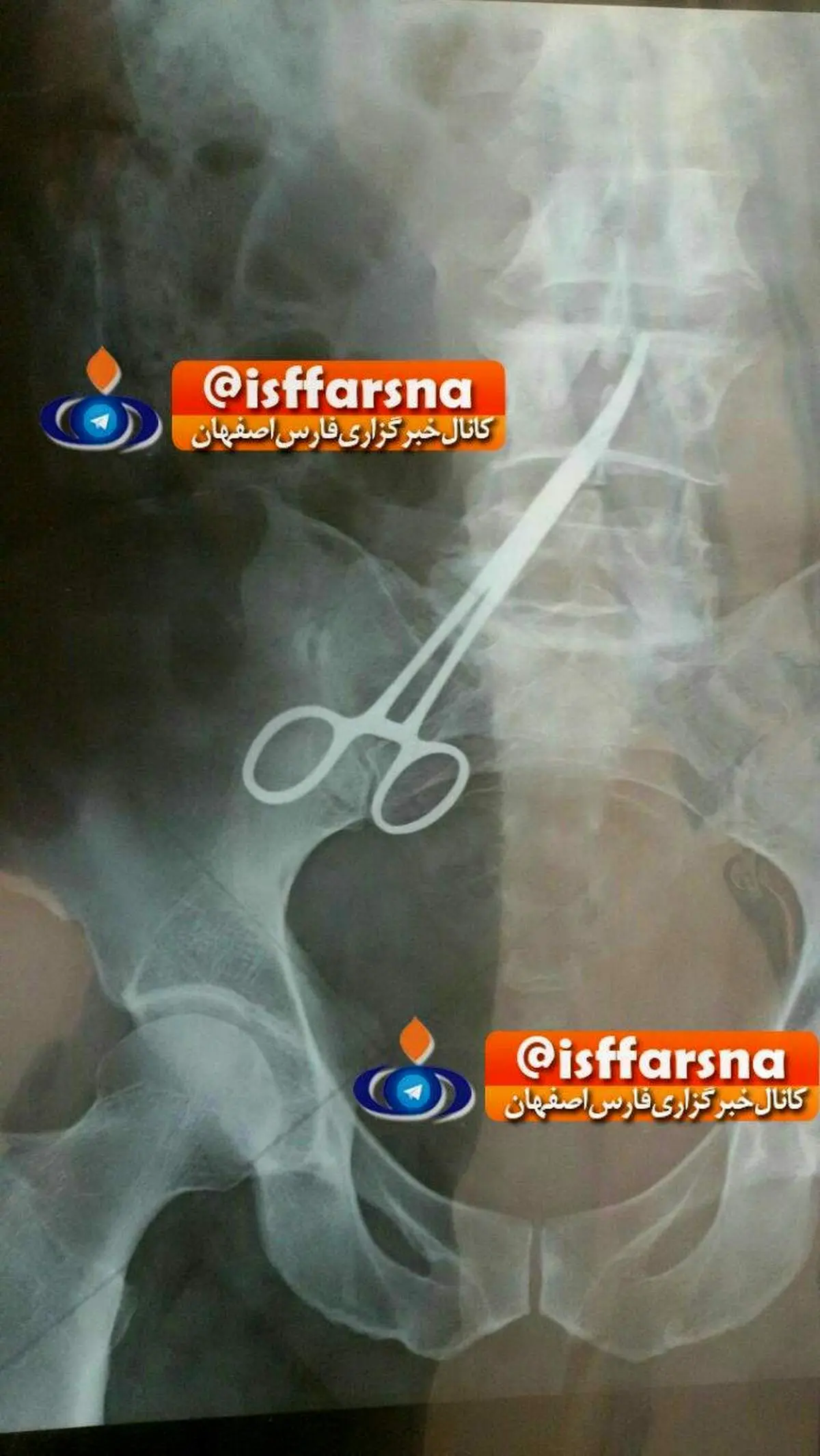 جا ماندن پنس ۲۵ سانتیمتری در شکم بیمار