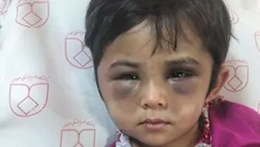 کودک آزار دیده با صورت کبود+عکس