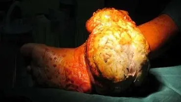 خروج تومور ۲ کیلویی از پای یک بیمار +عکس