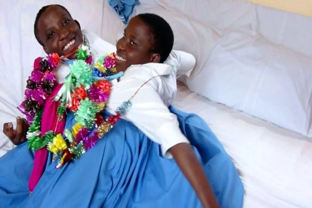 درگذشت دو قلو‌های به هم چسبیده تانزانیایی پس از ۲۲ سال