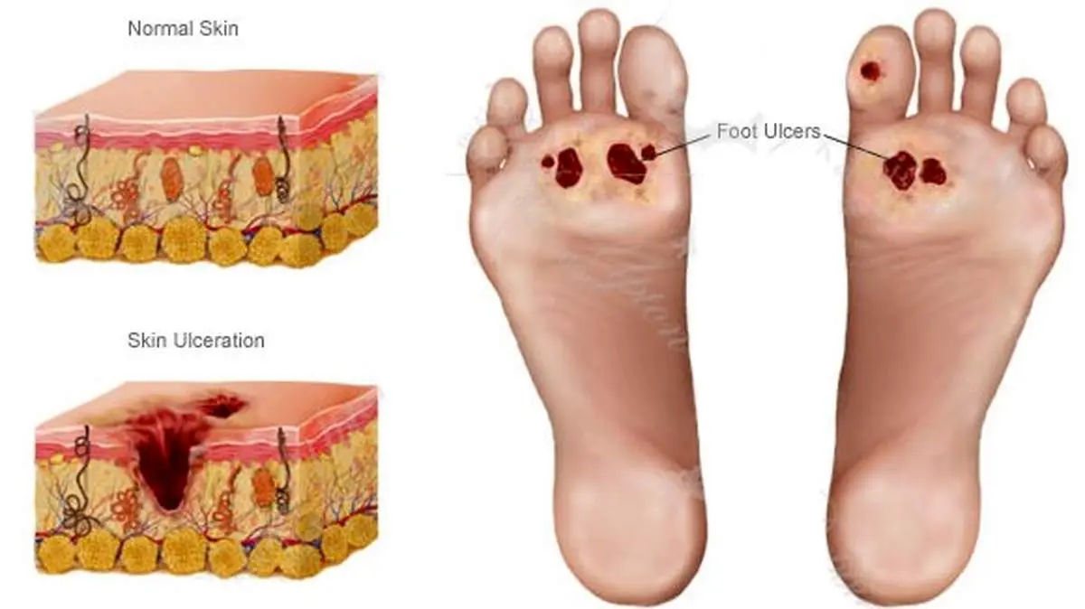 طب سنتی برای درمان زخم پای دیابتی