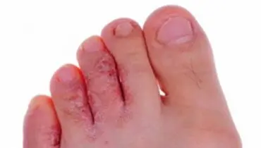 هر آنچه که باید درباره قارچ پوستی و راه‌های پیشگیری از آن بدانید