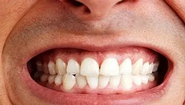 همه آنچه از «دندان قروچه» نمی‌دانید