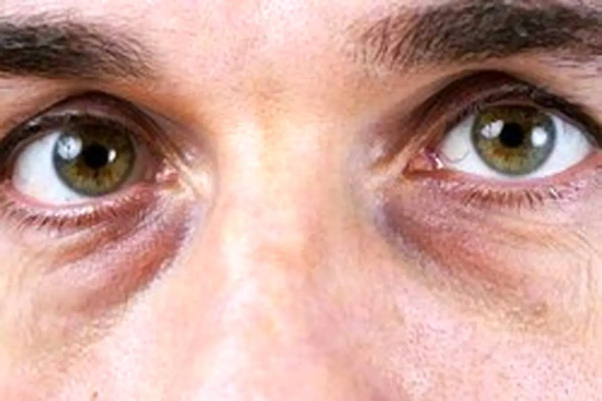 آیا روزه‌داری برای کسانی که نزدیک بین هستند و شماره عینک‌شان بالاست ممنوع است؟