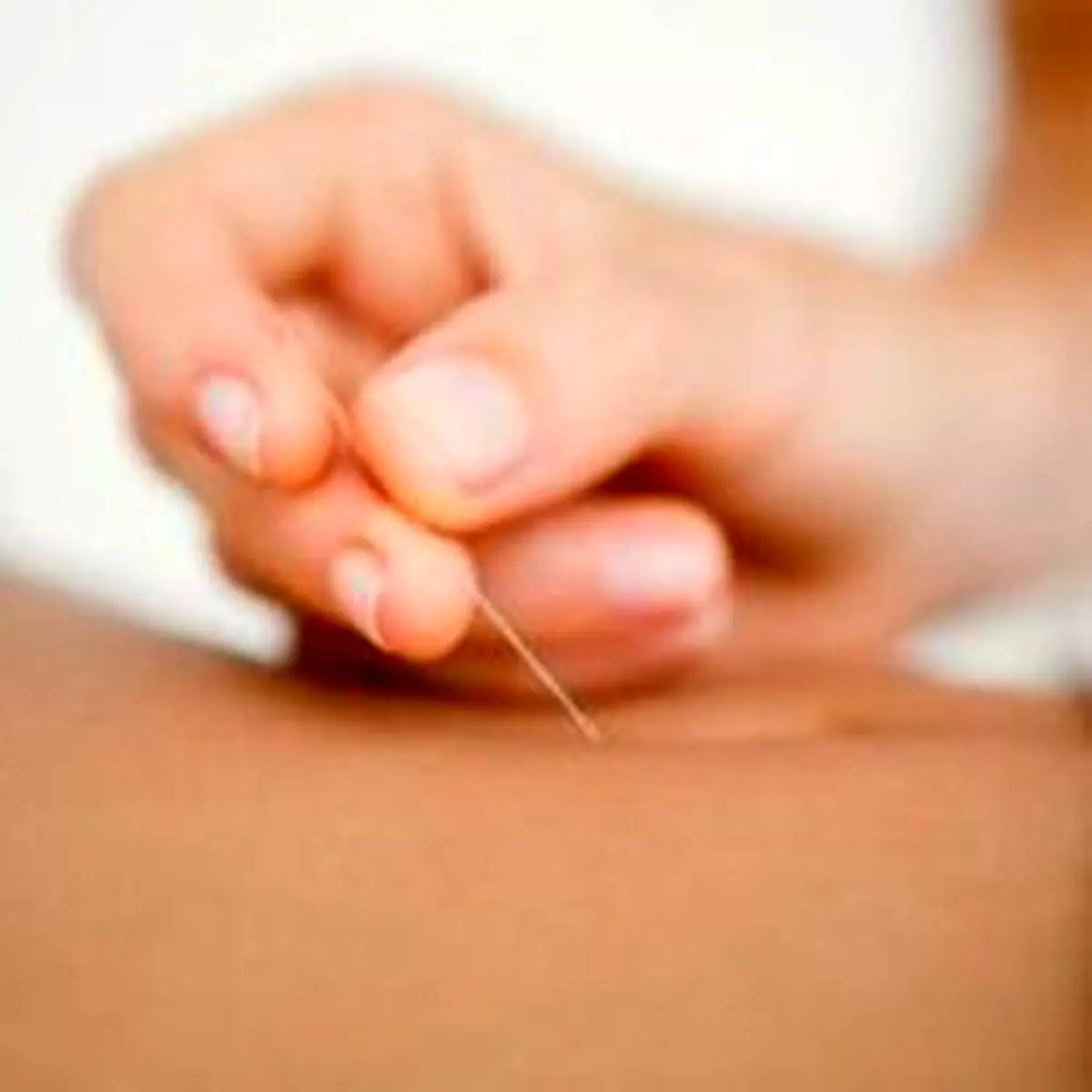 لاغر کردن شکم با استفاده از طب سوزنی
