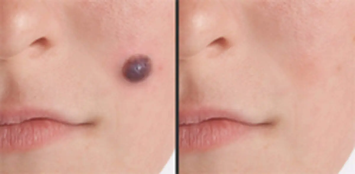 نکاتی درباره برداشتن خال‌ها