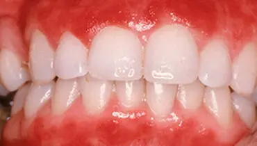 دلیل خون ریزی لثه چیست؟