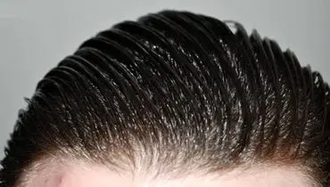 دلیل چرب شدن مو‌ها چیست