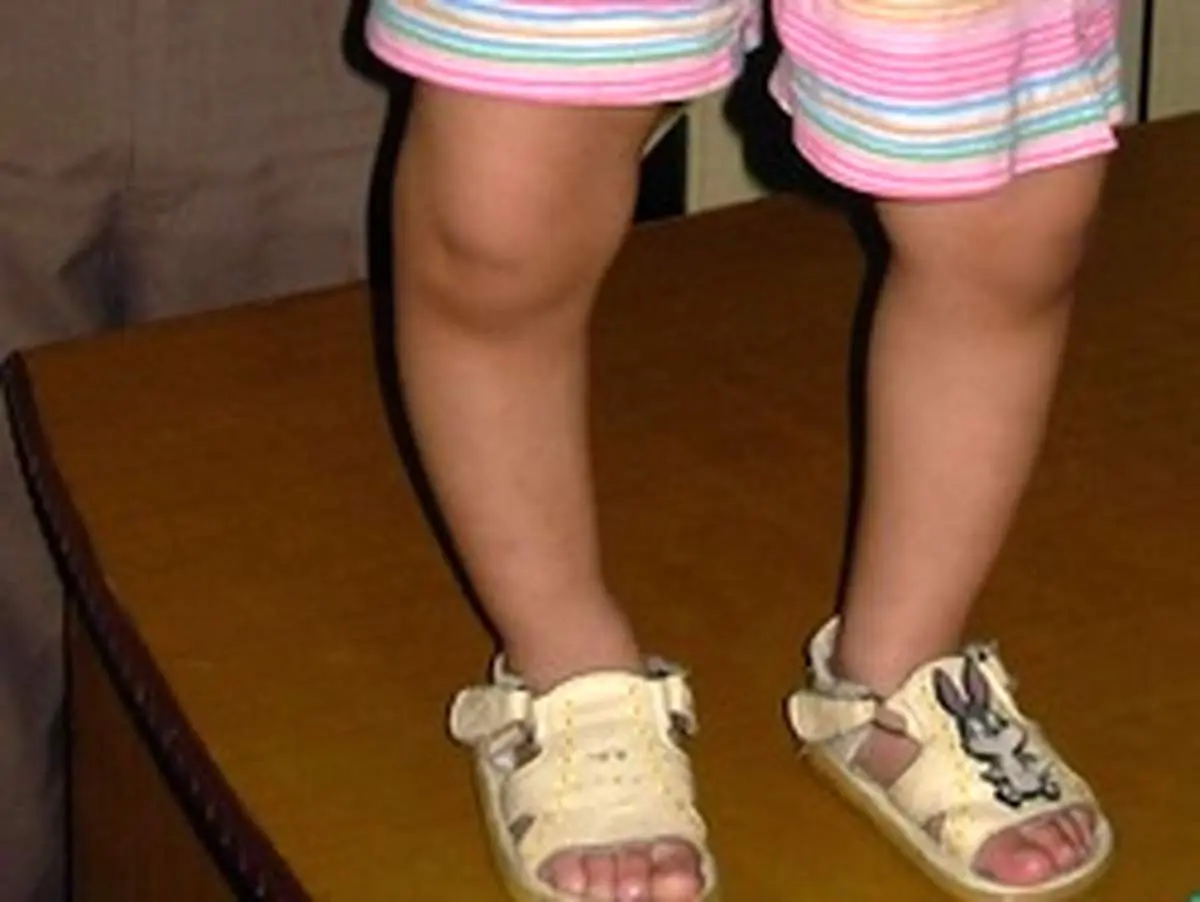 راشیتیسم کودکان چگونه درمان می شود