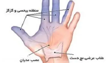 علت ایجاد گزگز دست و روش‌های درمان آن