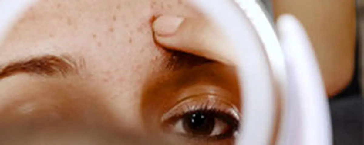 ۱۱ درمان خانگی جوش پیشانی