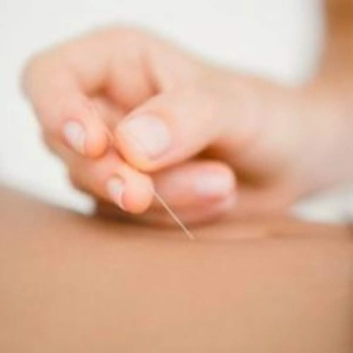 لاغر کردن شکم با استفاده از طب سوزنی