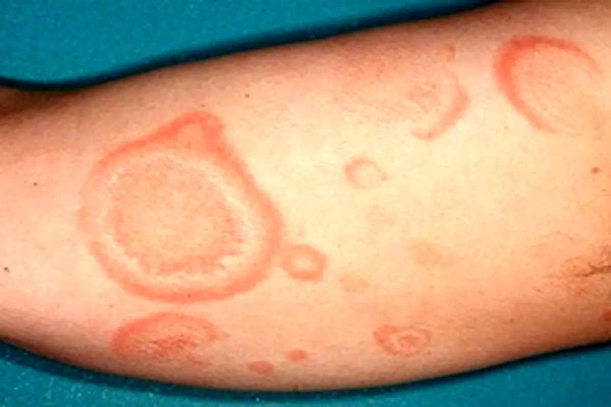 نشانه‌های عفونت پوست را بشناسید